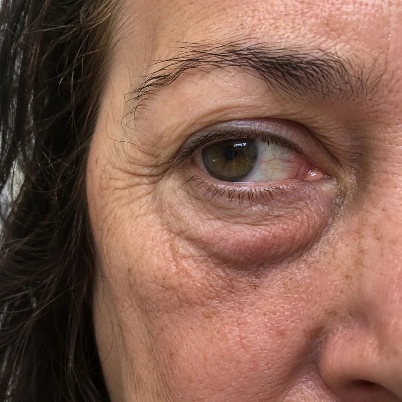 Wallen en donkere kringen onder het oog