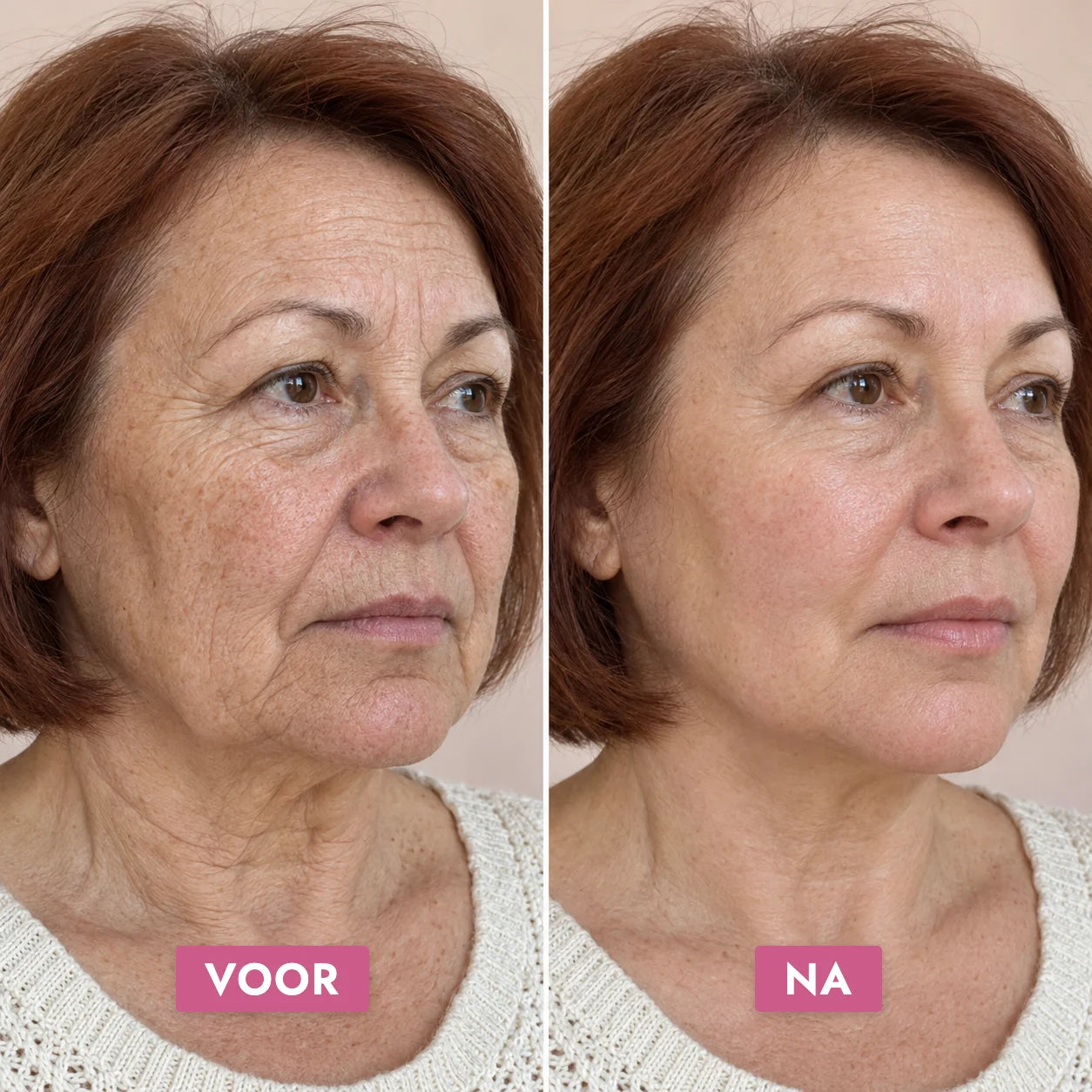 Retinol Alternative Crème — voor en na